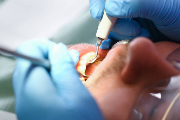 Best Emergency Dentist for Knocked-Out Tooth in Decatur, GA