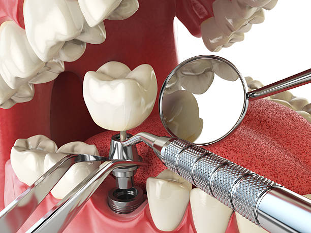 Best Broken or Cracked Tooth Emergency Dentist in Decatur, GA